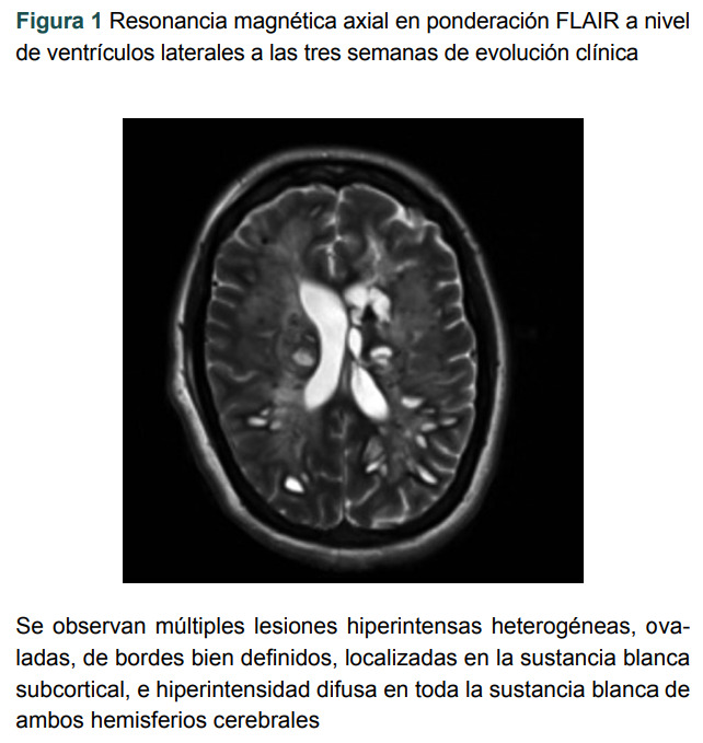 [Acute hemorrhagic leukoencephalopathy. Case report].