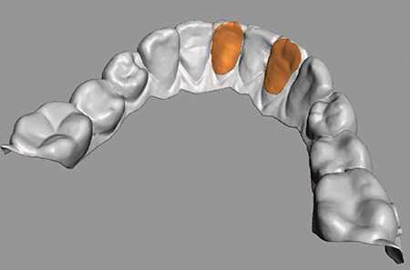 Directly Printed Aligner: Aligning with the Future.