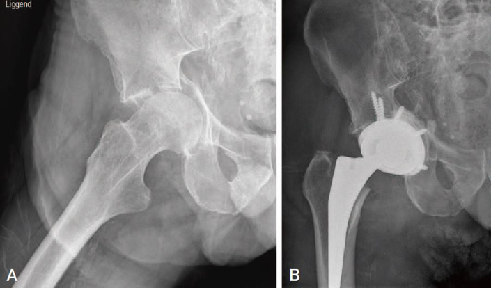 Total Hip Arthroplasty with Cemented Dual Mobility Cup into a Fully Porous Multihole Cup with Variable Angle Locking Screws for Acetabular Fractures in the Frail Elderly.