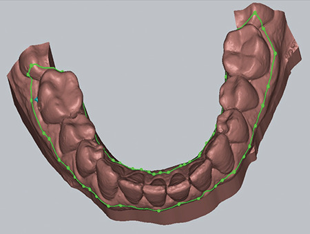 Directly Printed Aligner: Aligning with the Future.