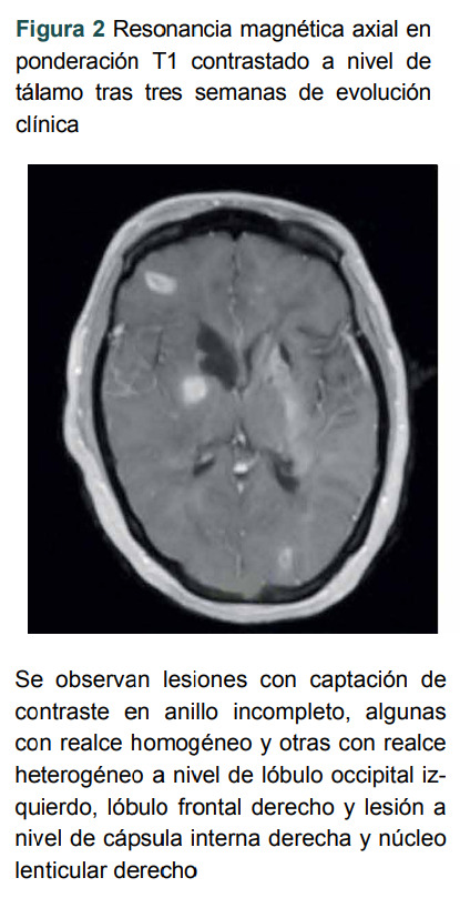 [Acute hemorrhagic leukoencephalopathy. Case report].