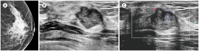 Benign Adenomyoepithelioma of the Breast: Imaging Characteristics.