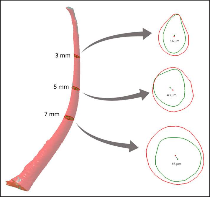 Shaping Ability of F6 SkyTaper®, Hyflex® EDM One File, and One Curve®: A Micro-computed Tomographic Evaluation in Curved Root Canals.