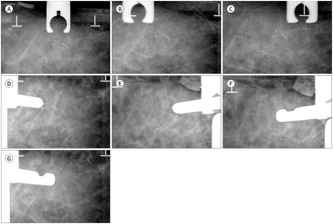 [Mammography-Guided Interventional Procedure].