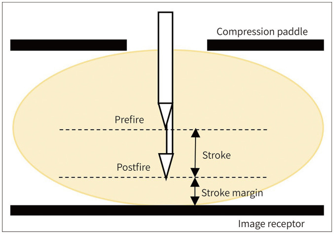 [Mammography-Guided Interventional Procedure].