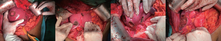 Parenchymal-sparing hepatectomy for multiple bilobar colorectal liver metastases in a Jehovah's witness: a case report.