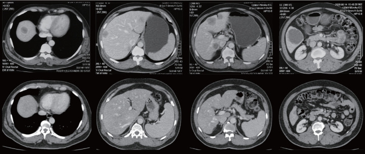 Parenchymal-sparing hepatectomy for multiple bilobar colorectal liver metastases in a Jehovah's witness: a case report.