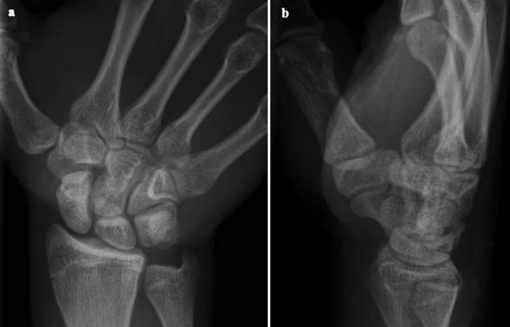 Transverse carpal ligament tear at the trapezial ridge without fracture - the "trapezial ridge line" sign: two case reports.