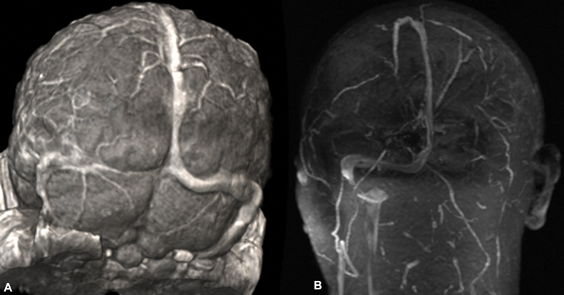 An Illustrative Case of Vein of Labbe Thrombosis Presented as a Glioma.