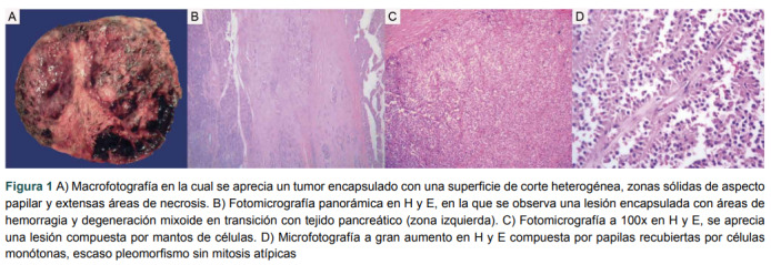 [Solid pseudopapillary neoplasm. Report of three cases and review of the literature].