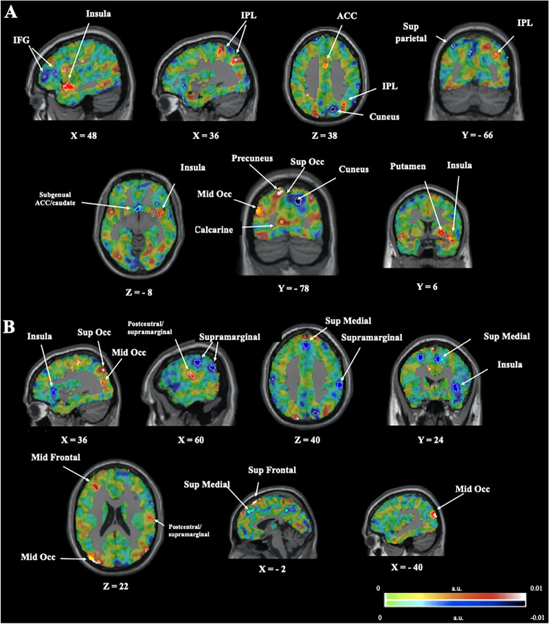 Emotion regulation in bipolar disorder type-I: multivariate analysis of fMRI data.