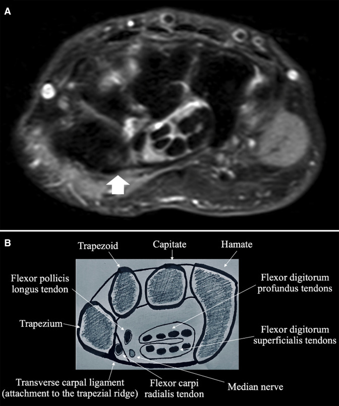 Transverse carpal ligament tear at the trapezial ridge without fracture - the "trapezial ridge line" sign: two case reports.