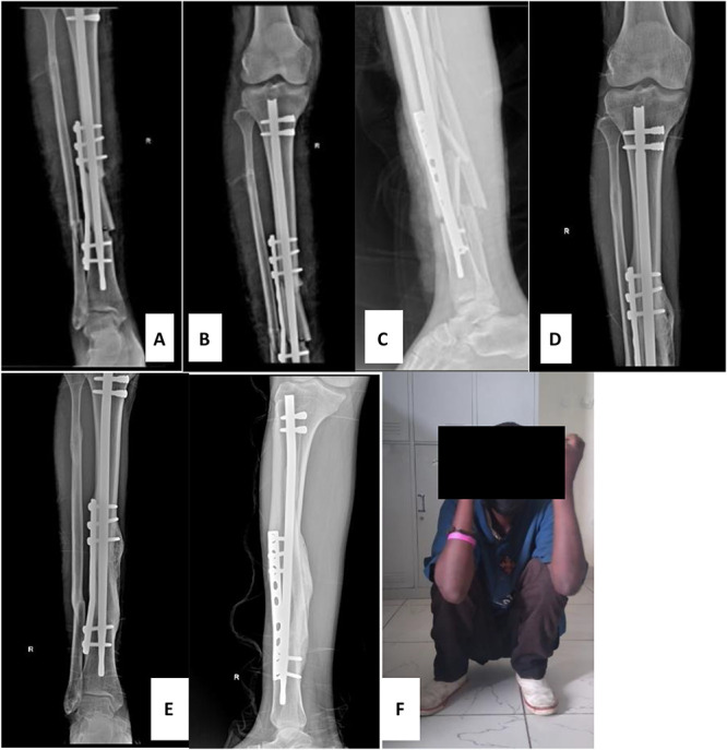 Outcome of tibial shaft fractures treated with the SIGN FIN nail at Addis Ababa Emergency, Burn, and Trauma Hospital (AaEBT) Addis Ababa, Ethiopia.