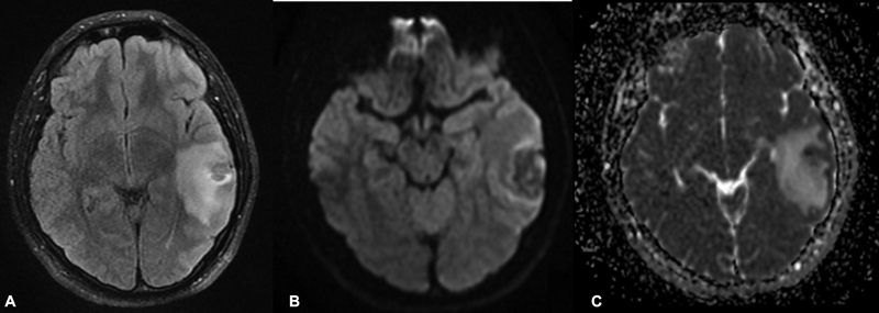 An Illustrative Case of Vein of Labbe Thrombosis Presented as a Glioma.