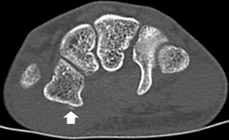 Transverse carpal ligament tear at the trapezial ridge without fracture - the "trapezial ridge line" sign: two case reports.