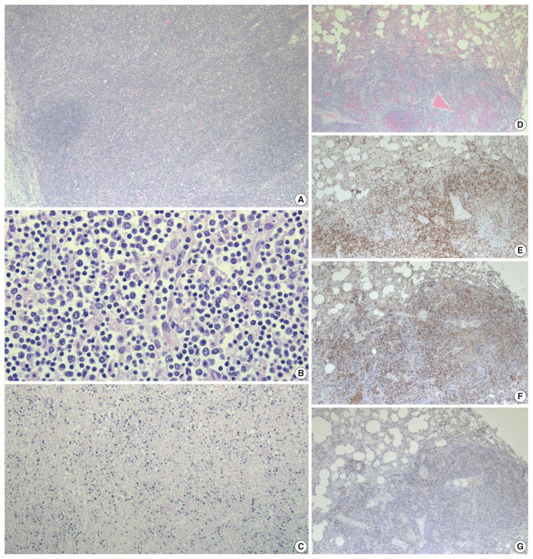 Unsuspected systemic Epstein-Barr virus-positive T-cell lymphoma of childhood diagnosed at autopsy in a potential homicide case.