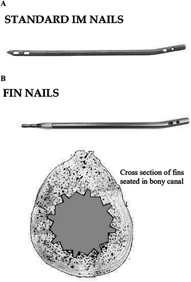 Outcome of tibial shaft fractures treated with the SIGN FIN nail at Addis Ababa Emergency, Burn, and Trauma Hospital (AaEBT) Addis Ababa, Ethiopia.