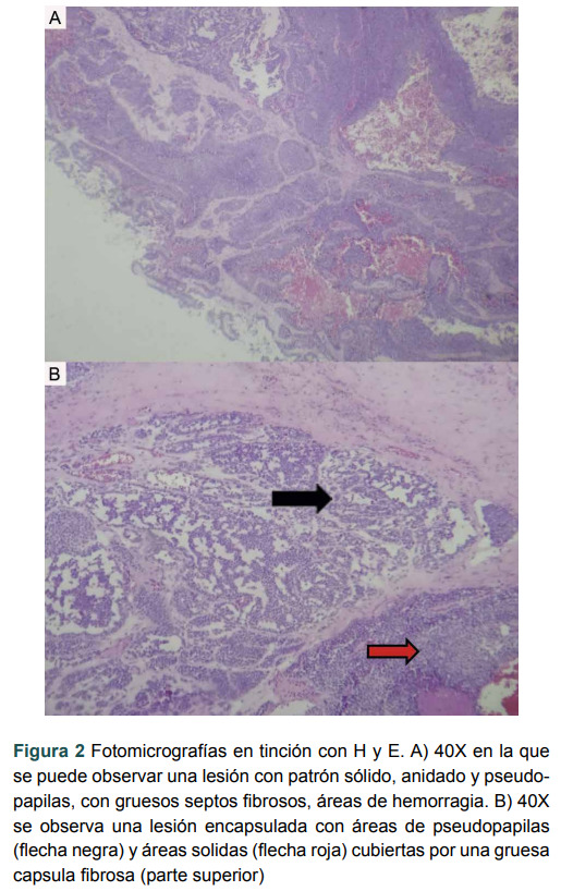 [Solid pseudopapillary neoplasm. Report of three cases and review of the literature].