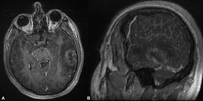 An Illustrative Case of Vein of Labbe Thrombosis Presented as a Glioma.