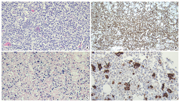 Unsuspected systemic Epstein-Barr virus-positive T-cell lymphoma of childhood diagnosed at autopsy in a potential homicide case.