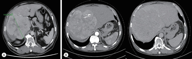 The development of hepatocellular carcinoma during long-term treatment for recurrent non-small cell lung cancer: a case report.