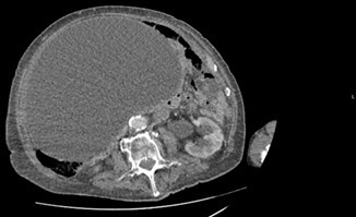 Unusual case of a gigantic bladder mimicking a large pelvic cystic mass.