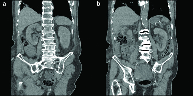 Unusual case of a gigantic bladder mimicking a large pelvic cystic mass.