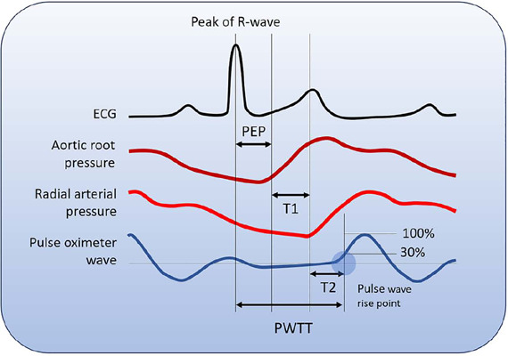 Estimated continuous cardiac output based on pulse wave transit time in critically ill children: a report of two cases.