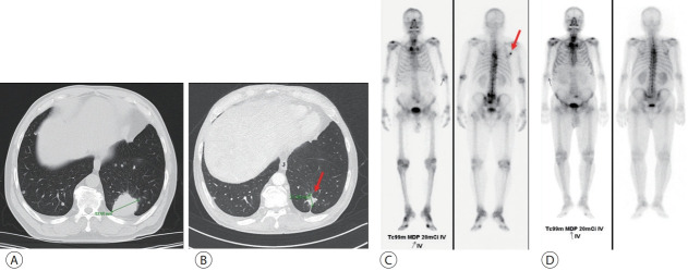 The development of hepatocellular carcinoma during long-term treatment for recurrent non-small cell lung cancer: a case report.