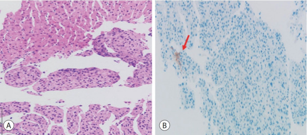 The development of hepatocellular carcinoma during long-term treatment for recurrent non-small cell lung cancer: a case report.