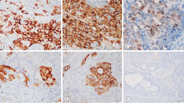 Adult hepatoblastoma: making the challenging distinction from hepatocellular carcinoma.