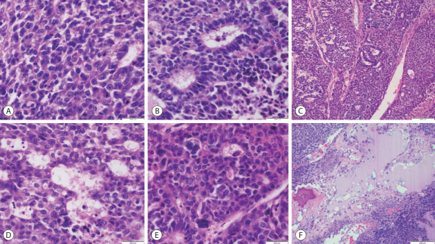 Adult hepatoblastoma: making the challenging distinction from hepatocellular carcinoma.