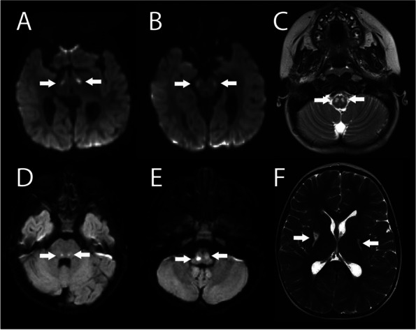 Case report: malignant hypertension associated with catecholamine excess in a patient with Leigh syndrome.