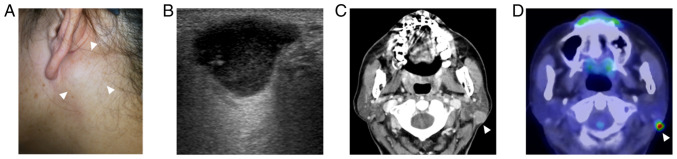 Epstein‑Barr virus‑associated lymphoepithelial carcinoma arising in the parotid gland: A case report and literature review.