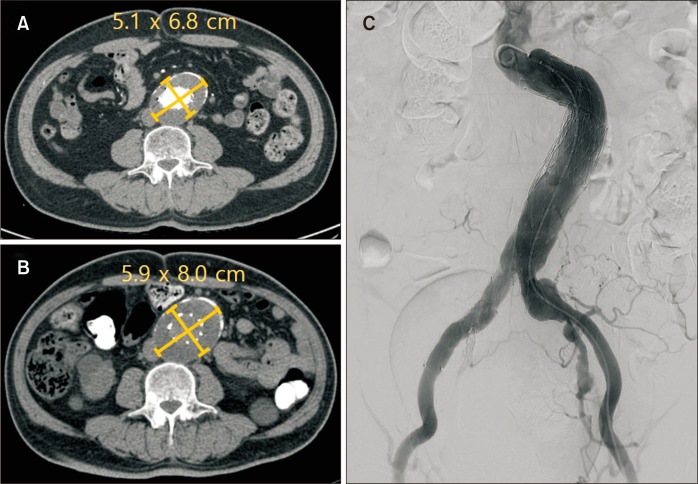 Late Type III Endoleak after Loss of Component Overlap after EVAR with AFX2 Device: A Case Report.