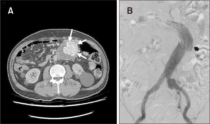 Late Type III Endoleak after Loss of Component Overlap after EVAR with AFX2 Device: A Case Report.