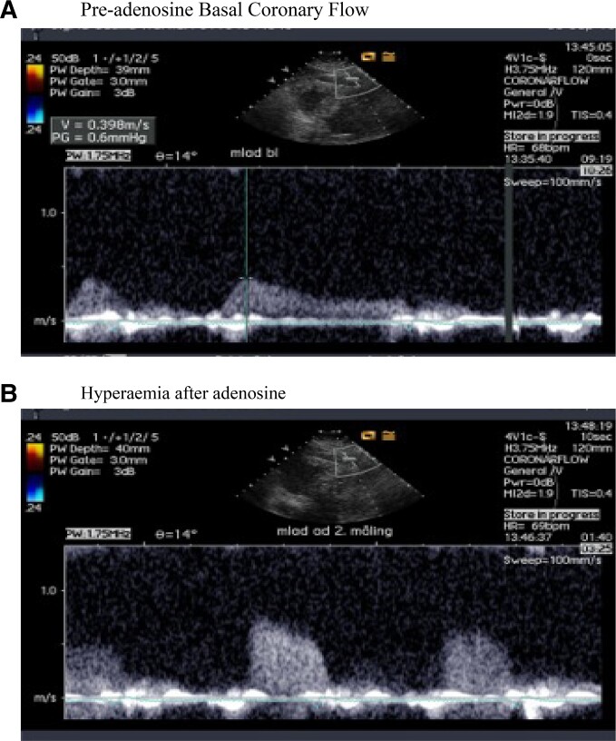 Aerobic high-intensity interval exercise training in patients with angina and no obstructive coronary artery disease: feasibility and physiological effects.