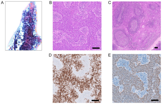 Epstein‑Barr virus‑associated lymphoepithelial carcinoma arising in the parotid gland: A case report and literature review.