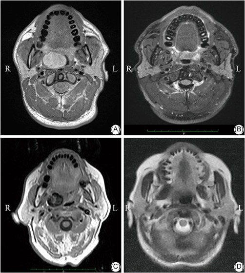 Endoscopy-assisted transoral approach for parapharyngeal space tumors: Our experience and a systematic review of the literature.