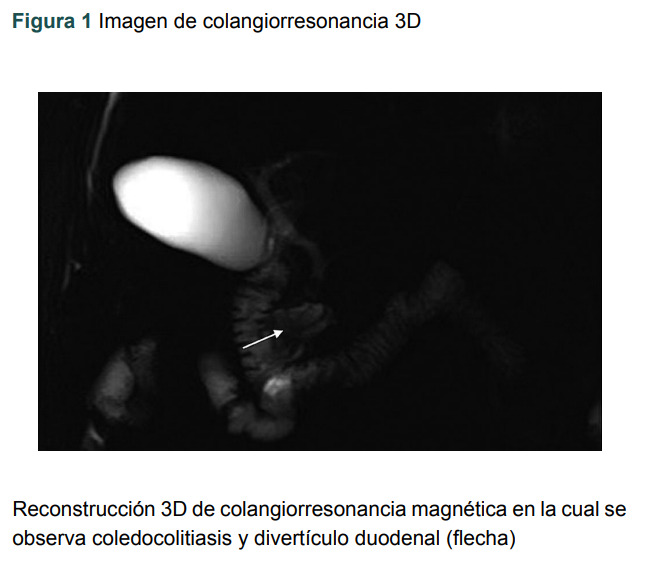 [Acute cholangitis secondary to periampullary duodenal diverticulum. Case report].