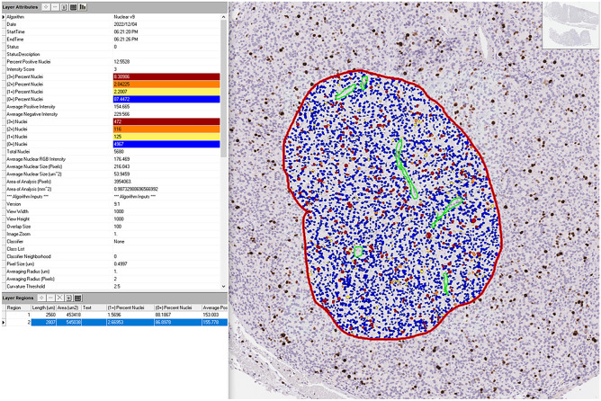 Diagnostic, Prognostic, and Predictive Role of Ki67 Proliferative Index in Neuroendocrine and Endocrine Neoplasms: Past, Present, and Future.