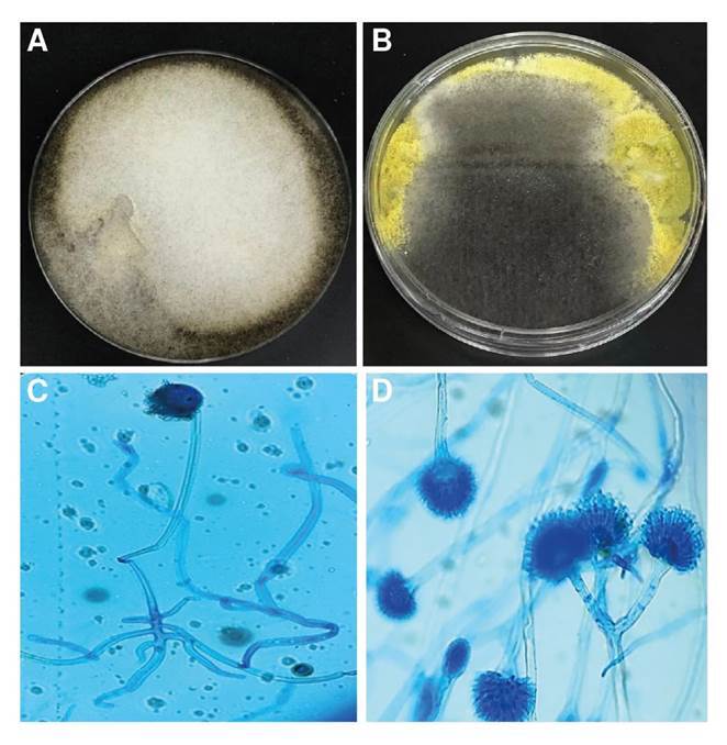 Infection due to Aspergillus flavus and Rhizopus oryzae complex in a patient with diabetes mellitus