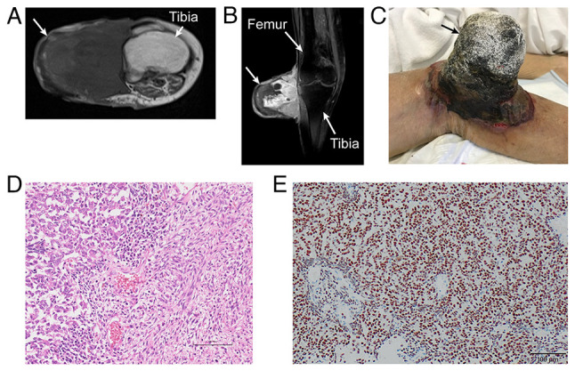 Reconstruction of the lateral collateral ligament using the plantaris tendon after wide excision of soft tissue sarcoma of the knee: A case report.