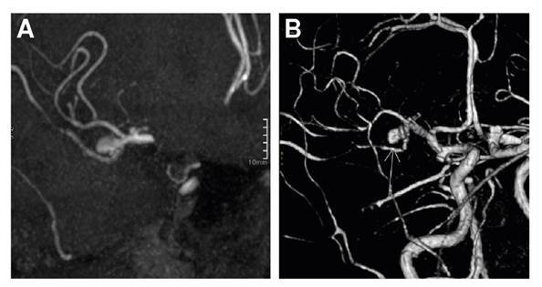 Infection due to Aspergillus flavus and Rhizopus oryzae complex in a patient with diabetes mellitus