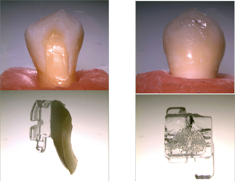 <i>In Vitro</i> Evaluation of the Effects of Different Chemical Solvent Agents on Shear Bond Strength of Ceramic Orthodontic Brackets.