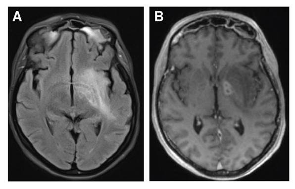 Infection due to Aspergillus flavus and Rhizopus oryzae complex in a patient with diabetes mellitus