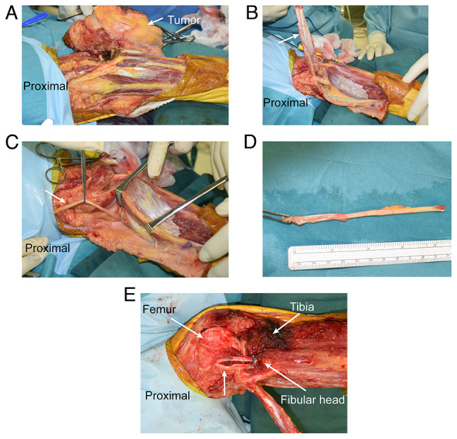 Reconstruction of the lateral collateral ligament using the plantaris tendon after wide excision of soft tissue sarcoma of the knee: A case report.