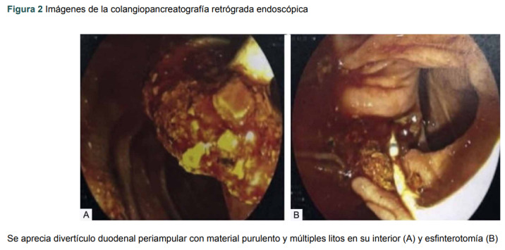 [Acute cholangitis secondary to periampullary duodenal diverticulum. Case report].