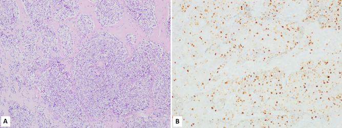 Diagnostic, Prognostic, and Predictive Role of Ki67 Proliferative Index in Neuroendocrine and Endocrine Neoplasms: Past, Present, and Future.