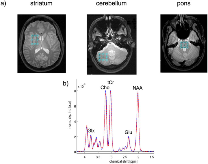 [WITHDRAWN] Serum biomarkers of liver fibrosis identify changes in striatal metabolite levels.